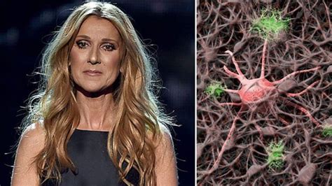 La malattia neurologica di Celine Dion: che cos’è la .